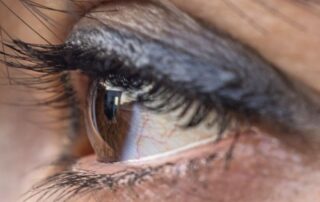 Sjogren’s Syndrome